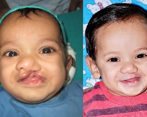 Best Pediatric Surgeon in Nagpur - Dr. Jitendra Hazare